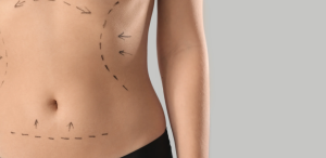 Tummy Tuck Costs in Arlington Virginia